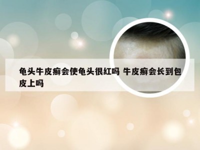 龟头牛皮癣会使龟头很红吗 牛皮癣会长到包皮上吗