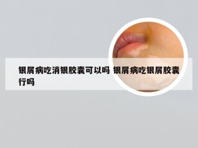 银屑病吃消银胶囊可以吗 银屑病吃银屑胶囊行吗