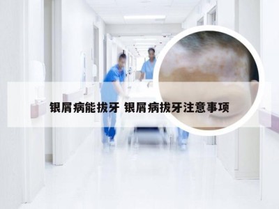 银屑病能拔牙 银屑病拔牙注意事项