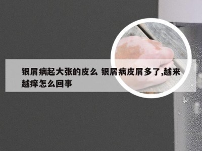 银屑病起大张的皮么 银屑病皮屑多了,越来越痒怎么回事