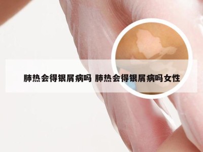 肺热会得银屑病吗 肺热会得银屑病吗女性
