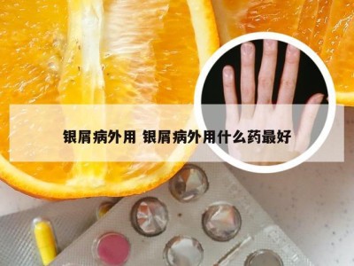 银屑病外用 银屑病外用什么药最好