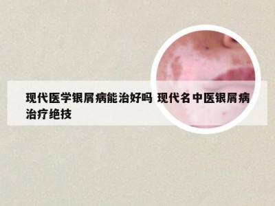 现代医学银屑病能治好吗 现代名中医银屑病治疗绝技