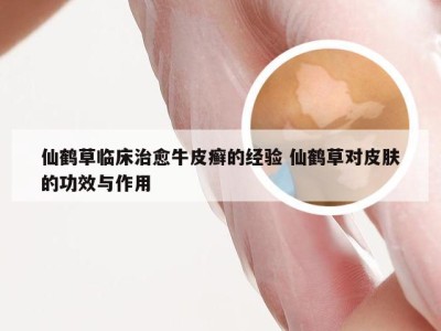 仙鹤草临床治愈牛皮癣的经验 仙鹤草对皮肤的功效与作用