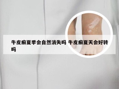 牛皮癣夏季会自然消失吗 牛皮癣夏天会好转吗