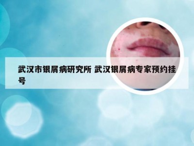 武汉市银屑病研究所 武汉银屑病专家预约挂号