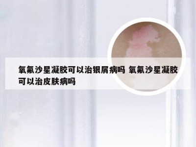 氧氟沙星凝胶可以治银屑病吗 氧氟沙星凝胶可以治皮肤病吗