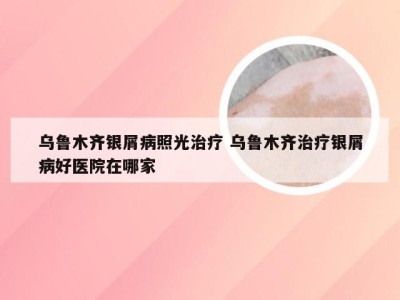 乌鲁木齐银屑病照光治疗 乌鲁木齐治疗银屑病好医院在哪家