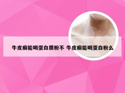 牛皮癣能喝蛋白质粉不 牛皮癣能喝蛋白粉么