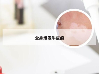 全身爆发牛皮癣