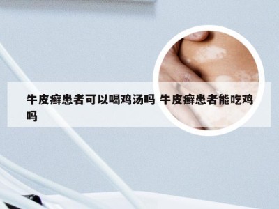 牛皮癣患者可以喝鸡汤吗 牛皮癣患者能吃鸡吗