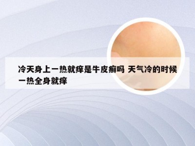 冷天身上一热就痒是牛皮癣吗 天气冷的时候一热全身就痒