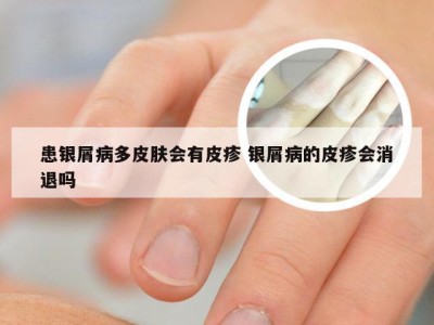 患银屑病多皮肤会有皮疹 银屑病的皮疹会消退吗
