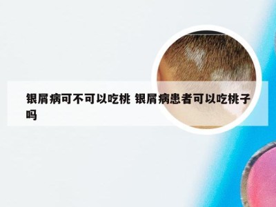 银屑病可不可以吃桃 银屑病患者可以吃桃子吗