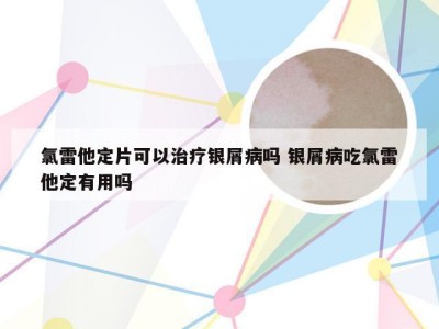 氯雷他定片可以治疗银屑病吗 银屑病吃氯雷他定有用吗