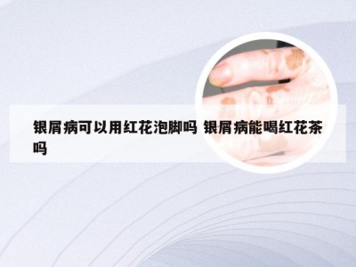 银屑病可以用红花泡脚吗 银屑病能喝红花茶吗
