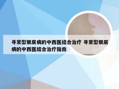 寻常型银屑病的中西医结合治疗 寻常型银屑病的中西医结合治疗指南