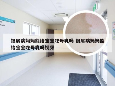 银屑病妈妈能给宝宝吃母乳吗 银屑病妈妈能给宝宝吃母乳吗视频
