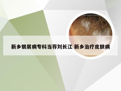 新乡银屑病专科当荐刘长江 新乡治疗皮肤病