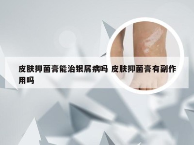 皮肤抑菌膏能治银屑病吗 皮肤抑菌膏有副作用吗