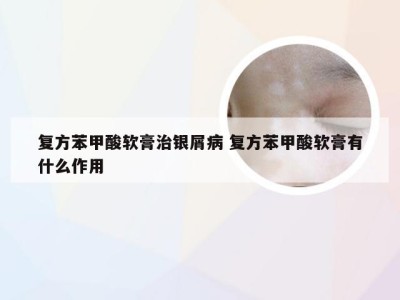 复方苯甲酸软膏治银屑病 复方苯甲酸软膏有什么作用