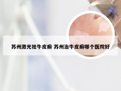 苏州激光祛牛皮癣 苏州治牛皮癣哪个医院好