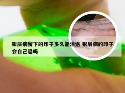 银屑病留下的印子多久能消退 银屑病的印子会自己退吗