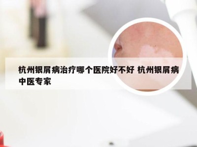 杭州银屑病治疗哪个医院好不好 杭州银屑病中医专家