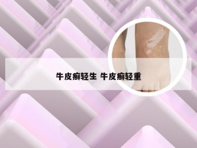 牛皮癣轻生 牛皮癣轻重