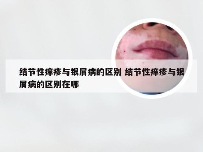 结节性痒疹与银屑病的区别 结节性痒疹与银屑病的区别在哪