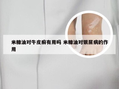 米糠油对牛皮癣有用吗 米糠油对银屑病的作用