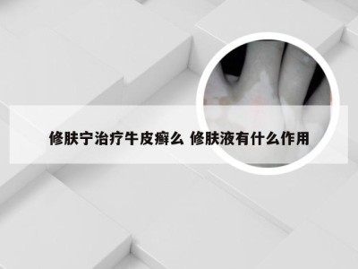 修肤宁治疗牛皮癣么 修肤液有什么作用