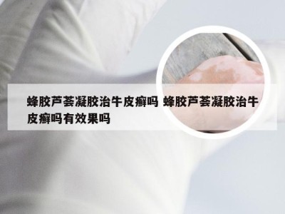 蜂胶芦荟凝胶治牛皮癣吗 蜂胶芦荟凝胶治牛皮癣吗有效果吗