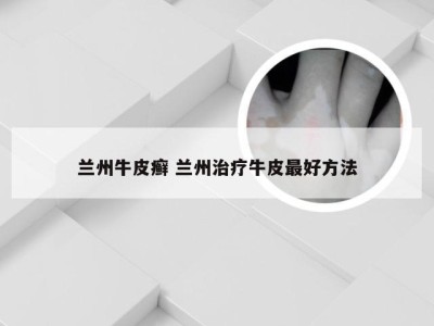 兰州牛皮癣 兰州治疗牛皮最好方法