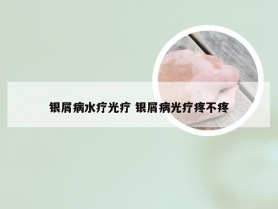 银屑病水疗光疗 银屑病光疗疼不疼