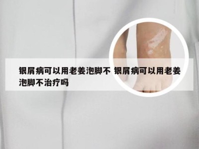 银屑病可以用老姜泡脚不 银屑病可以用老姜泡脚不治疗吗