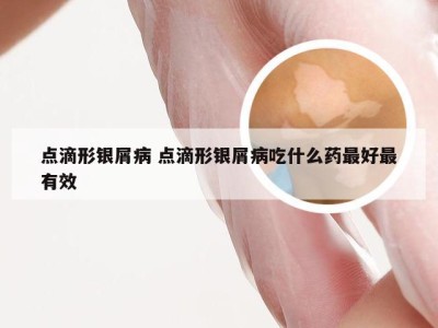 点滴形银屑病 点滴形银屑病吃什么药最好最有效