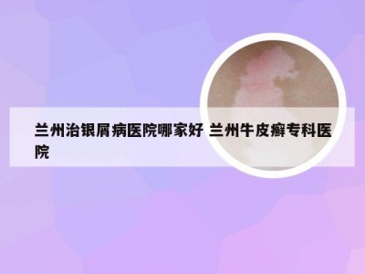 兰州治银屑病医院哪家好 兰州牛皮癣专科医院