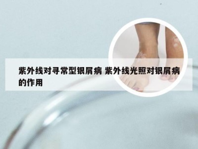 紫外线对寻常型银屑病 紫外线光照对银屑病的作用