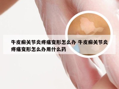 牛皮癣关节炎疼痛变形怎么办 牛皮癣关节炎疼痛变形怎么办用什么药