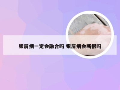 银屑病一定会融合吗 银屑病会断根吗