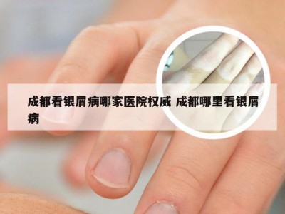 成都看银屑病哪家医院权威 成都哪里看银屑病