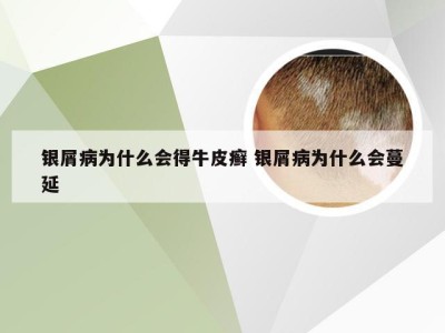 银屑病为什么会得牛皮癣 银屑病为什么会蔓延