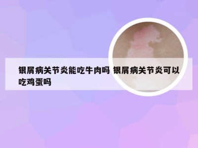 银屑病关节炎能吃牛肉吗 银屑病关节炎可以吃鸡蛋吗