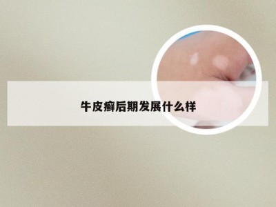 牛皮癣后期发展什么样