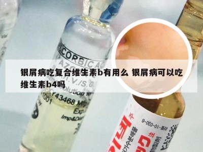 银屑病吃复合维生素b有用么 银屑病可以吃维生素b4吗