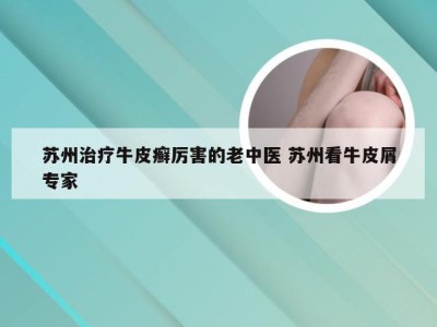 苏州治疗牛皮癣厉害的老中医 苏州看牛皮屑专家