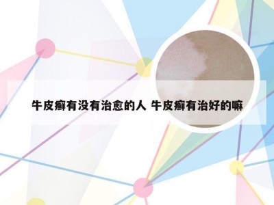 牛皮癣有没有治愈的人 牛皮癣有治好的嘛
