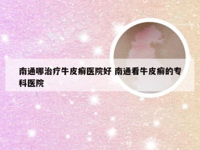 南通哪治疗牛皮癣医院好 南通看牛皮癣的专科医院