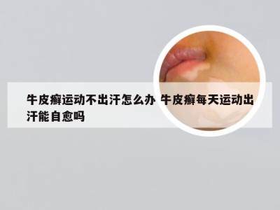 牛皮癣运动不出汗怎么办 牛皮癣每天运动出汗能自愈吗